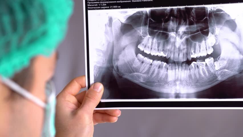 معرفی رادیوگرافی دندان و نحوه اجرا آن