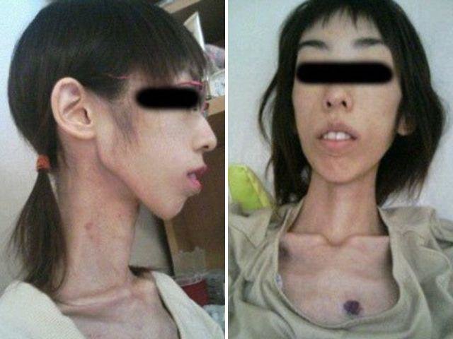 شکنجه وزن دختر ژاپنی را به ۱۷ کیلو رساند! + تصاویر