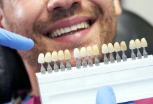 طول عمر لمینت دندان بیشتر است یا کامپوزیت؟